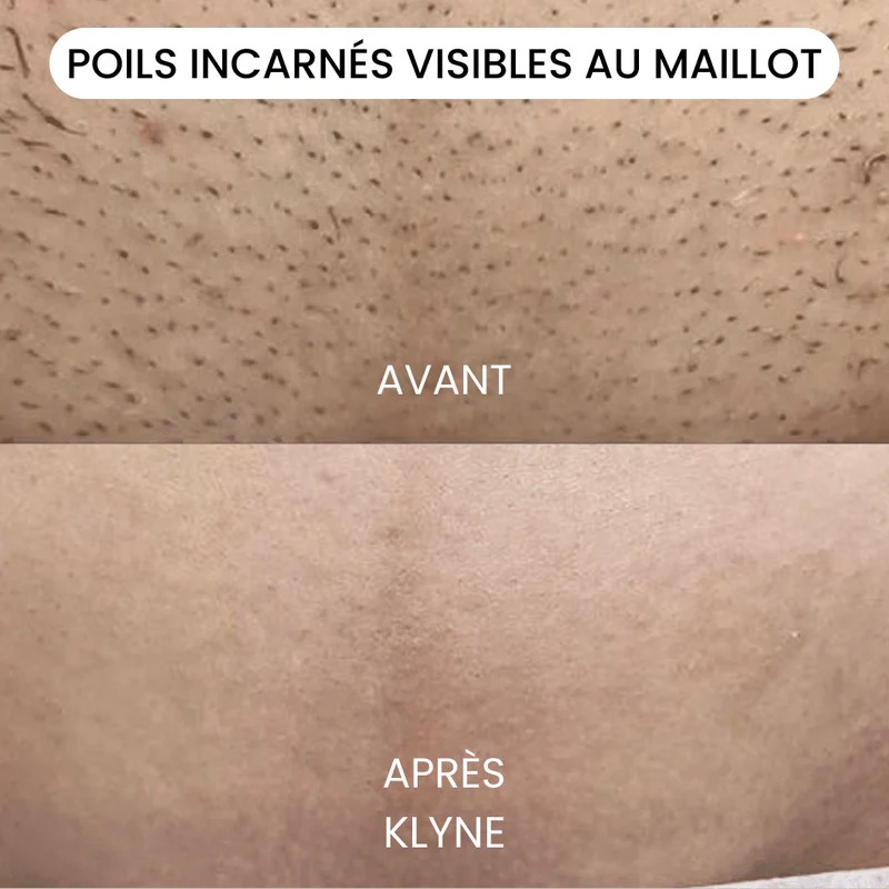 KLYNE®-rakhyvel – Rakningsinnovation för en mjuk och hälsosam hud