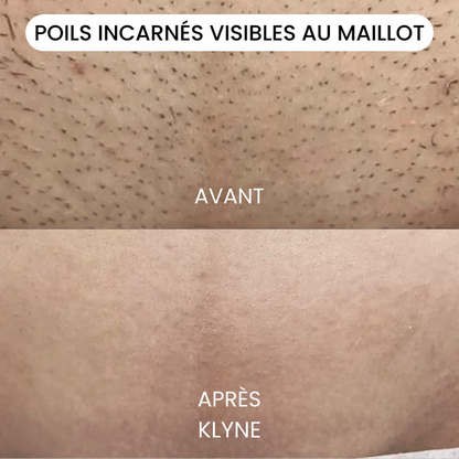 KLYNE®-rakhyvel – Rakningsinnovation för en mjuk och hälsosam hud